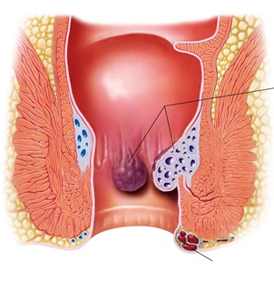 hemoroid